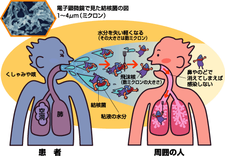 結核感染イラスト